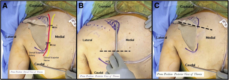 Treatment of snapping scapula 