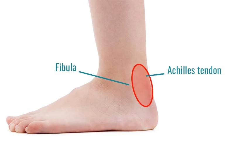 Posterior ankle impingement