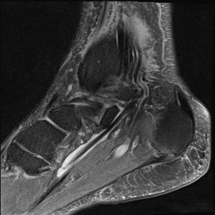 Flexor hallucis longus tenosynovitis