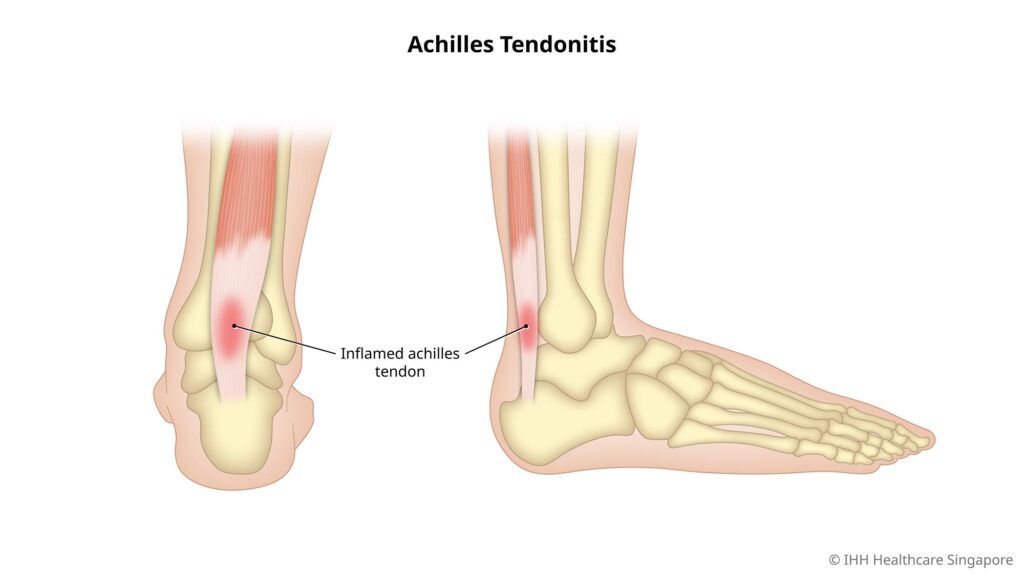 Achilles tendinitis