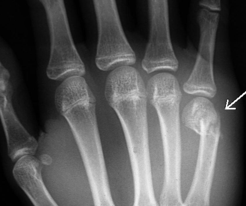 What is a boxer fracture