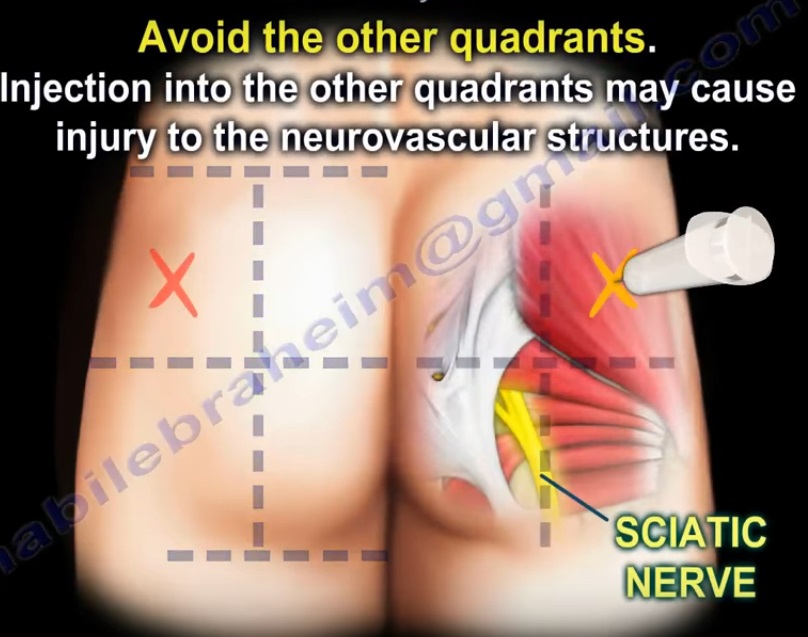 Buttock Injection