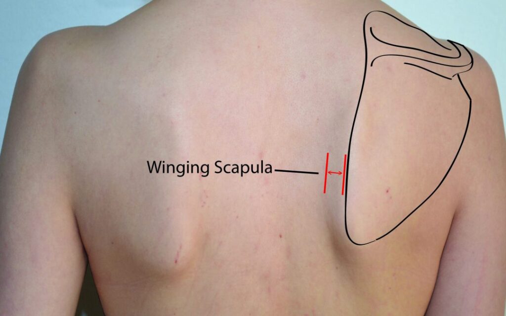 Winged scapula