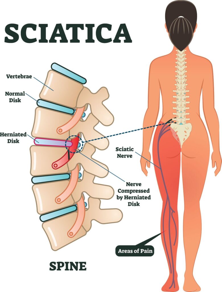 sciatica