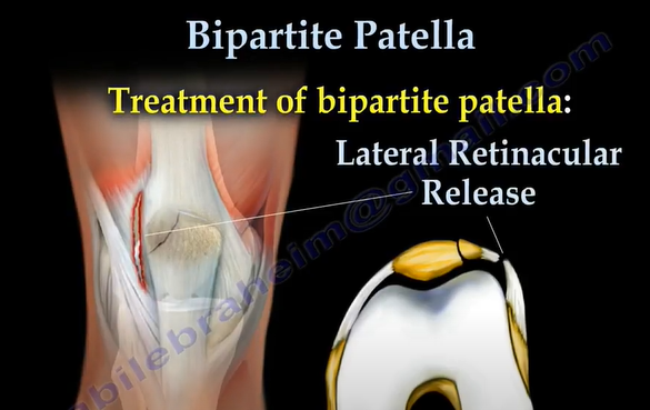 bipartite patella